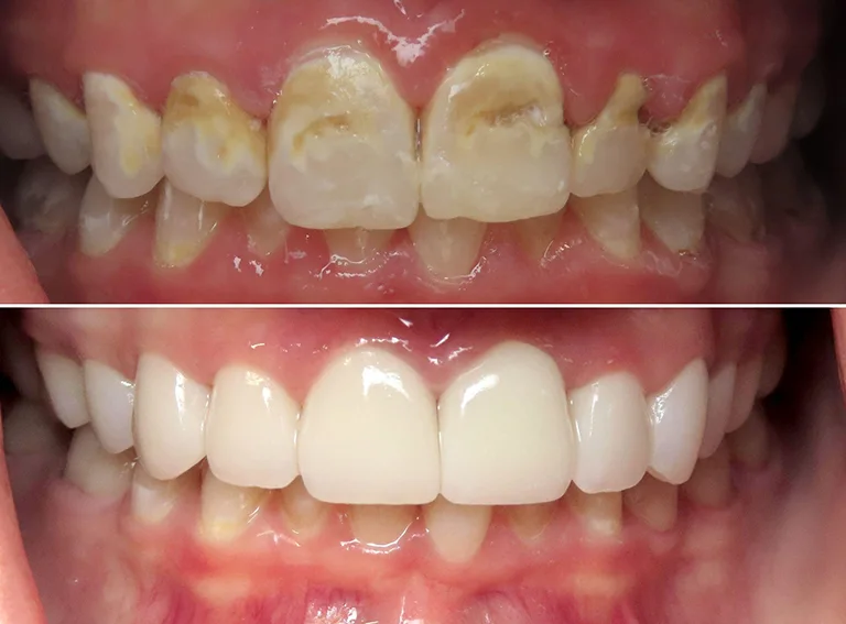 Smile Makeover Before and After