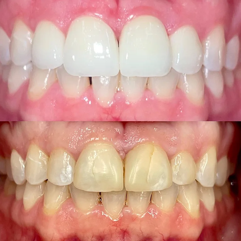Cosmetic Dentistry Before and After