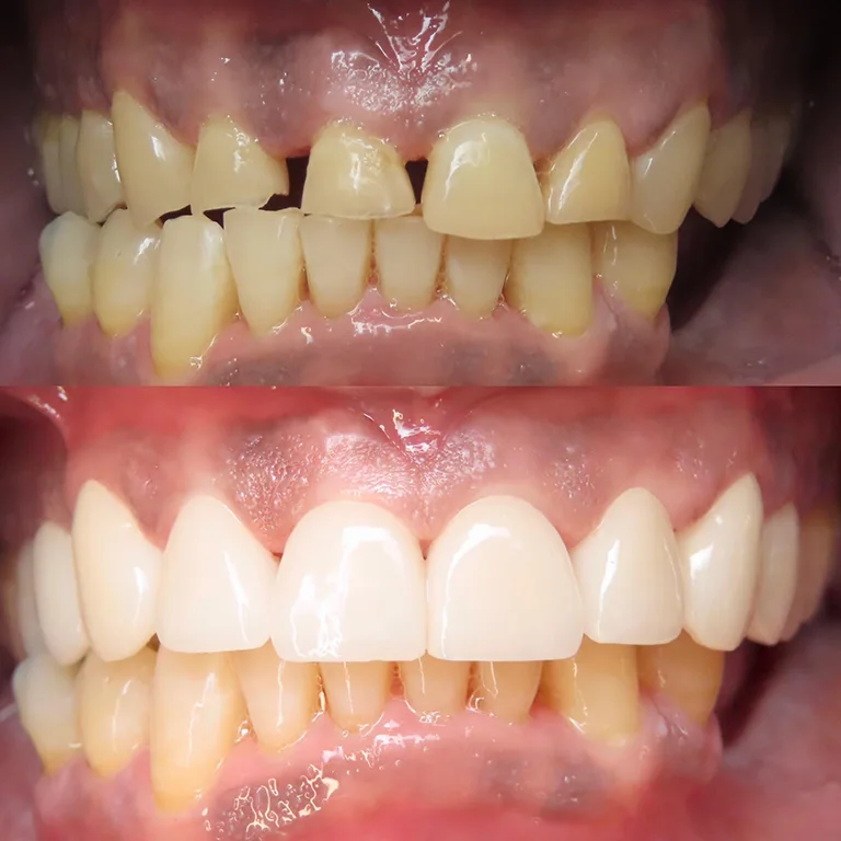 Orthodontics Before and After