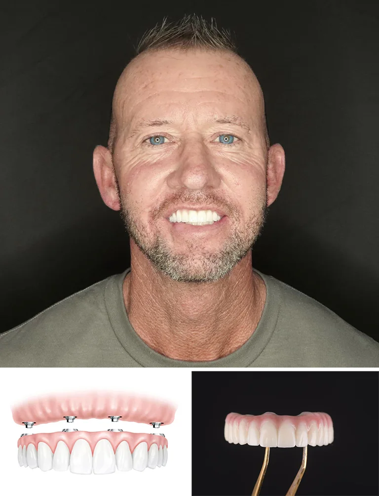 Dental Implants Before and After