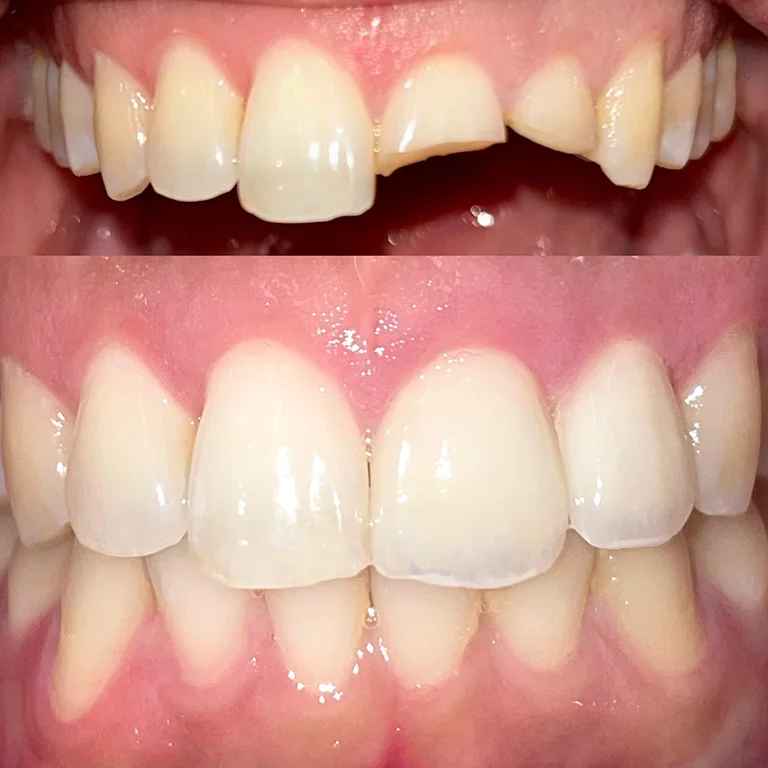 Emergency Dentistry Before and After